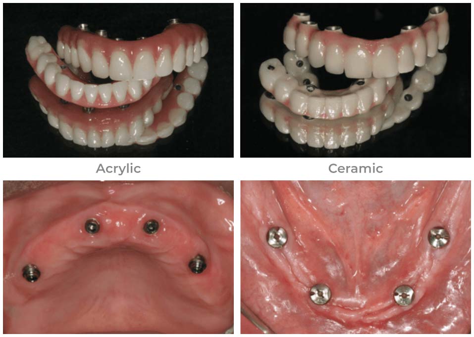 All-on-4 dental implant installation images