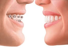 What is Invisalign®
