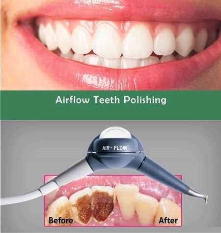 AirFlow Teeth Polishing