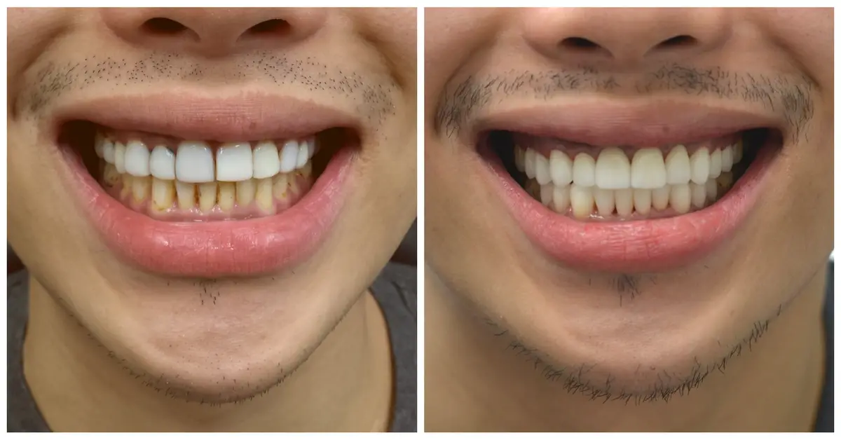 Before and After Crowns