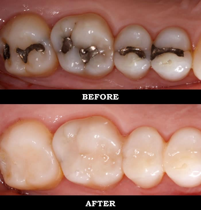 Before and After Resin Fillings