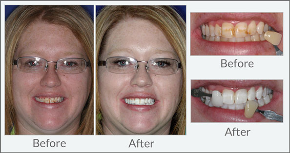 Before and After Lifetime Whitening