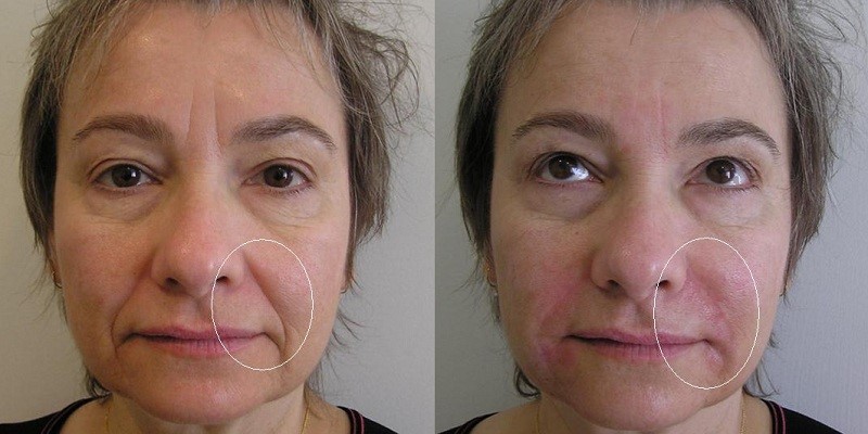 Injectables used on cheek