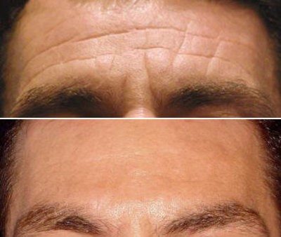 Injectable used on forehead