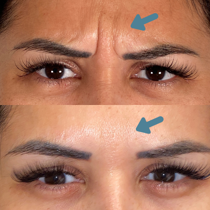 Injectables used on forehead