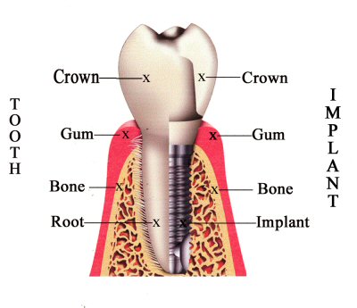 Implant Graphic 2