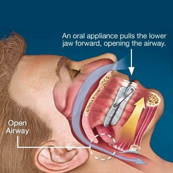 Sleep Apnea Oral Appliance Diagram